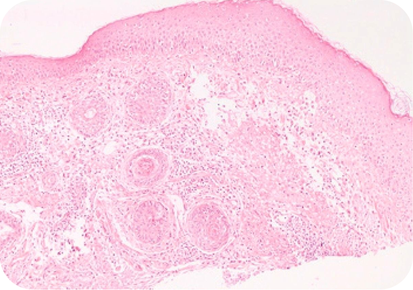 Rosacea Types, Triggers and Treatment Options