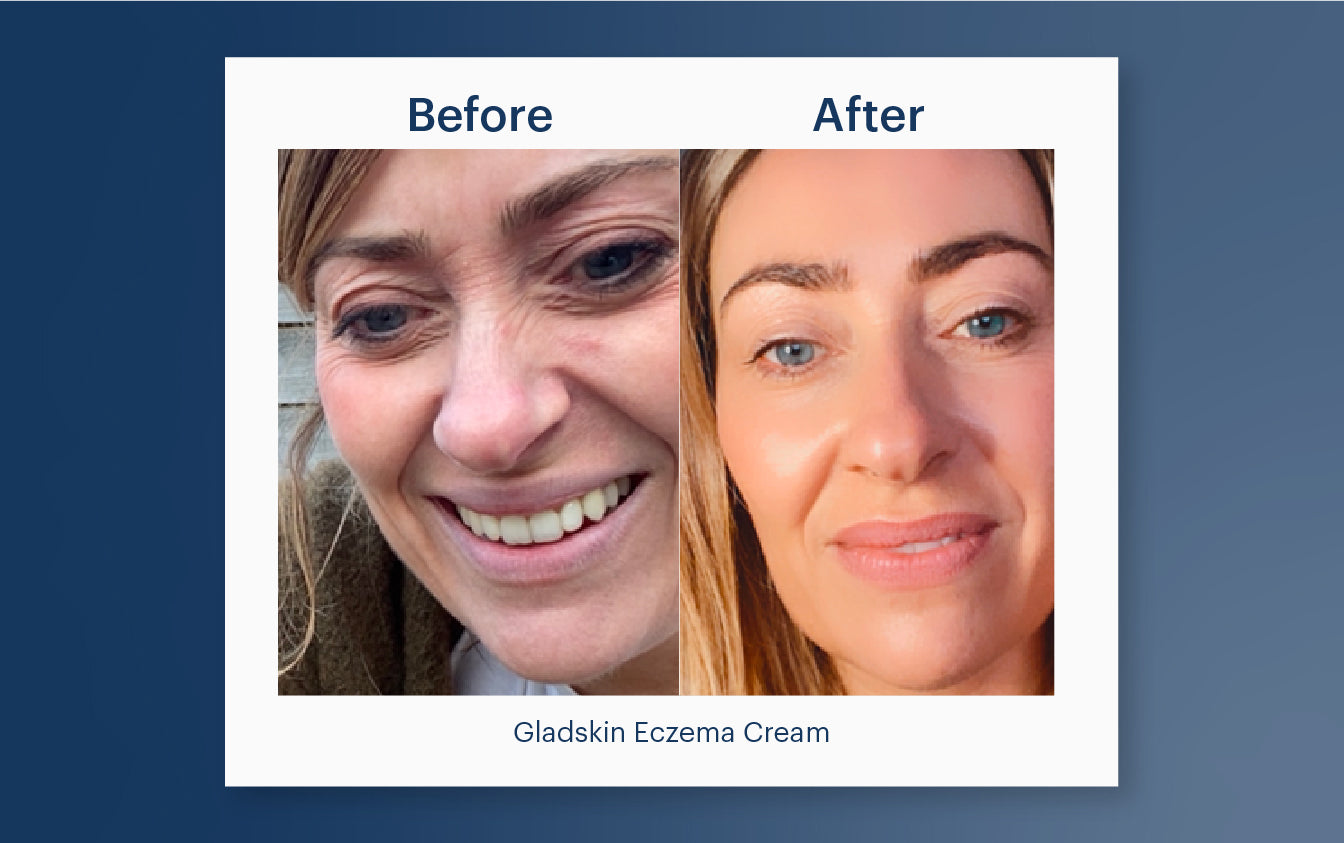 Skin Journey: Nicola Green