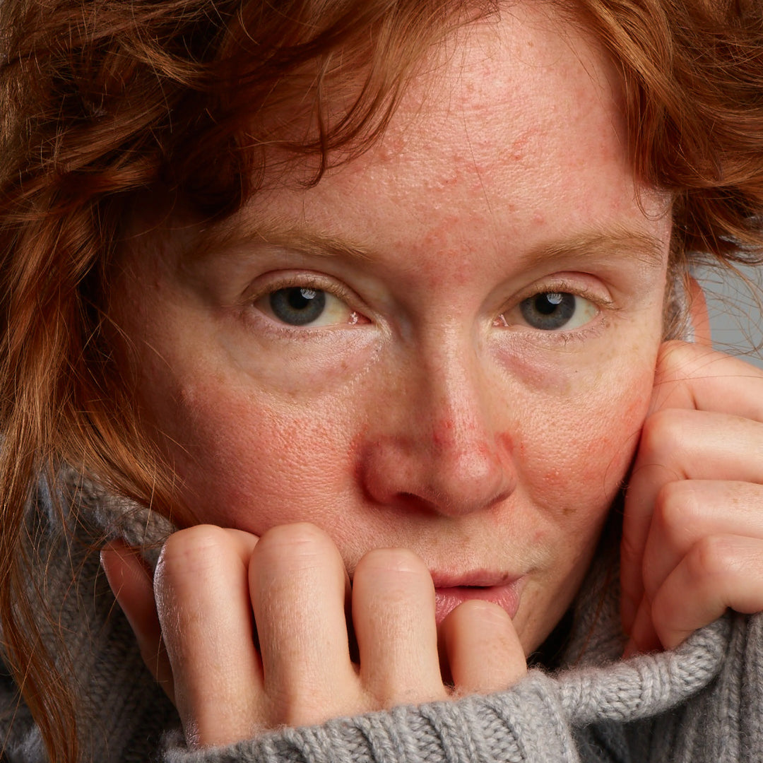 Lady affected by rosacea, who might need Gladskin Rosacear product