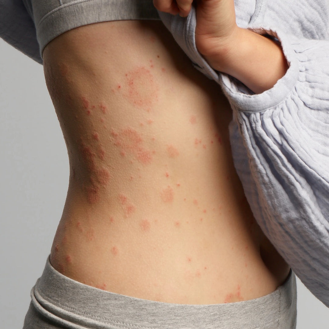 Body of a lady with eczema and blemishes