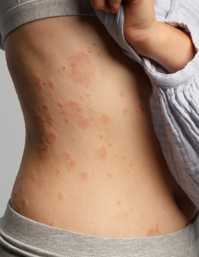 Eczemact Body Care Set Eczemact Body Care Set