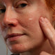 Lady with red face applying Gladskin gel on the face