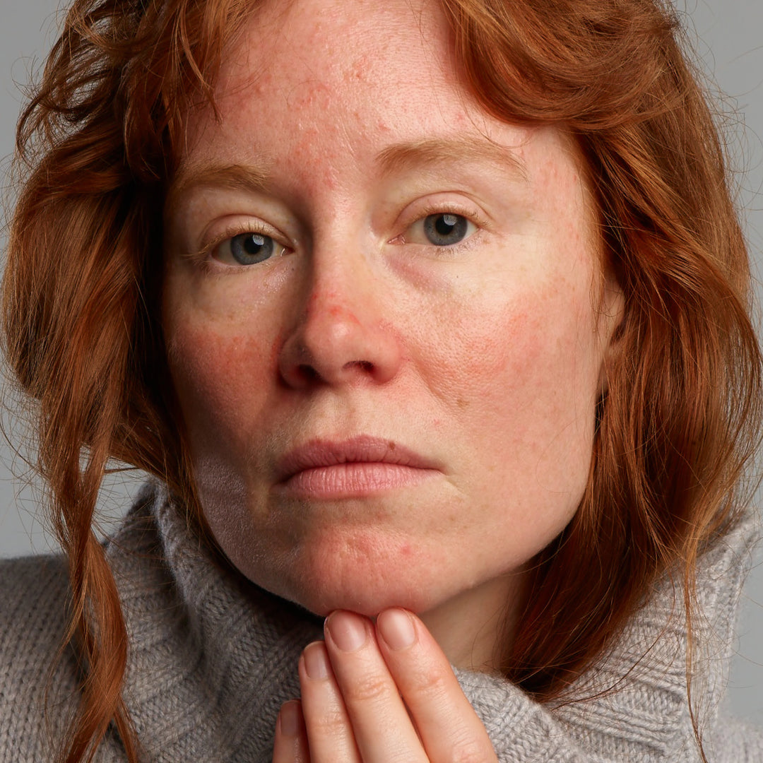 Lady affected by rosacea, who might need Gladskin Rosacear product