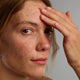Lady applying Acnefekt Gel on face