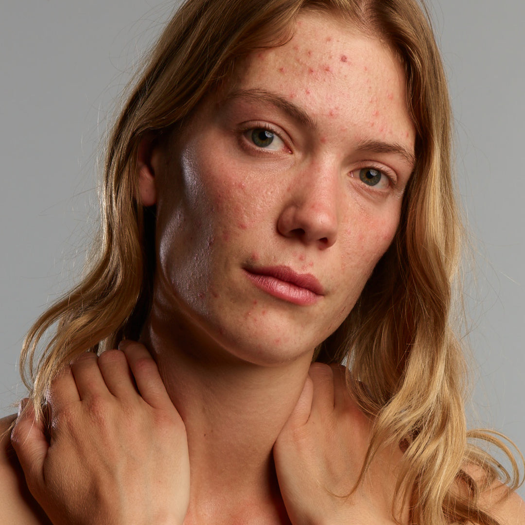 Lady with acne, could use Gladskin Acnefekt Gel