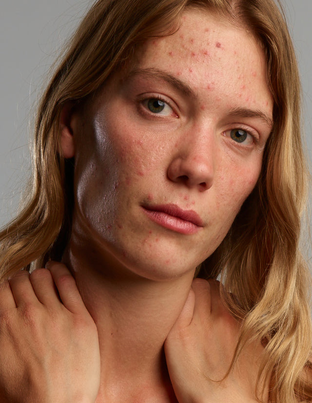 ACNEFEKT Moisturising Set, ideal routine to treat and moisturize acne-prone skin