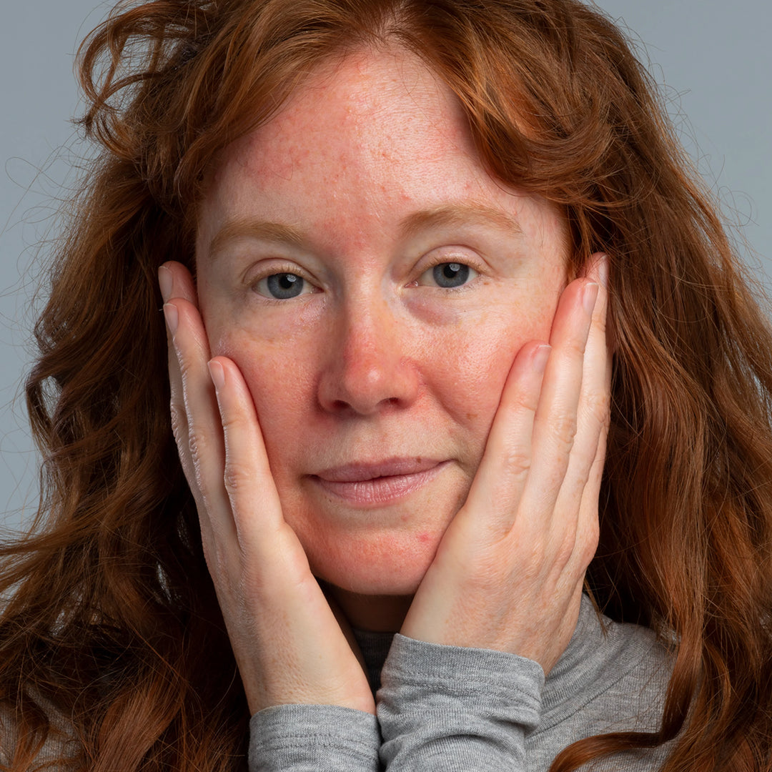 Lady affected by rosacea