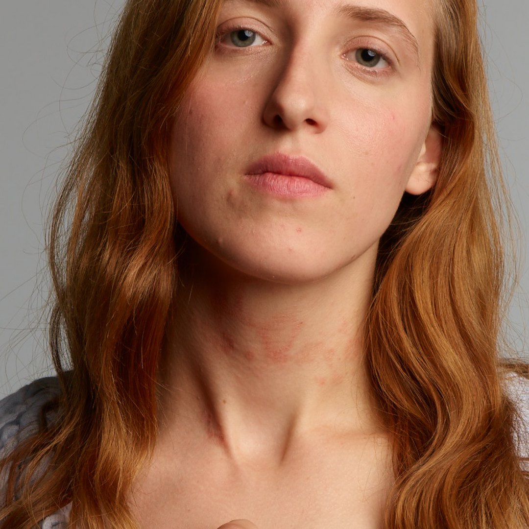 Lady with eczema signs on the neck