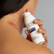 Eczemact Cream application on lady's neck