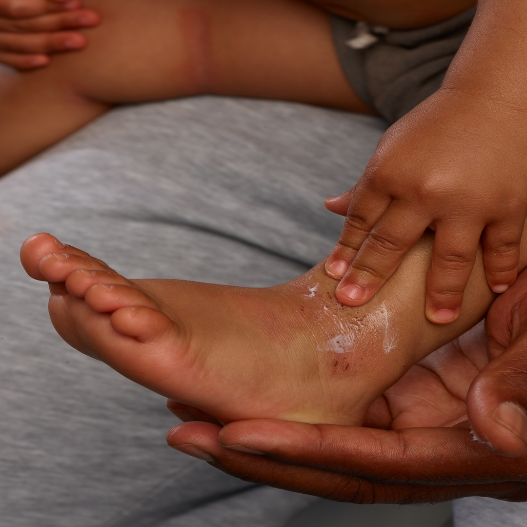 Eczemact Gel applied on baby legs